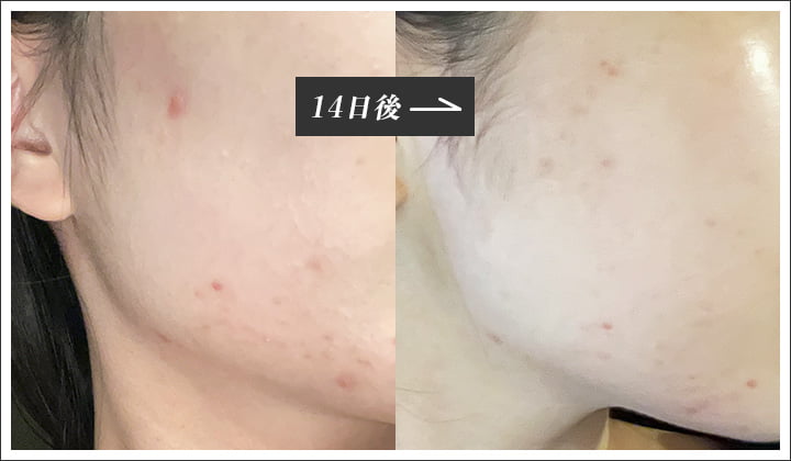 14日後の肌の比較画像